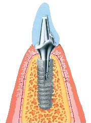 implant